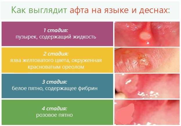 Стоматит на десне. Мази, лечение детей, взрослых