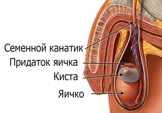 Киста придатка яичка у мужчин. Последствия сперматоцеле