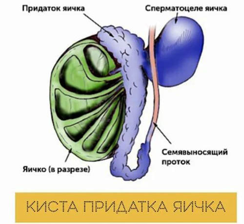 Киста придатка яичка у мужчин. Последствия сперматоцеле