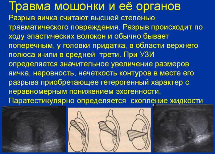 Киста придатка яичка у мужчин. Последствия сперматоцеле