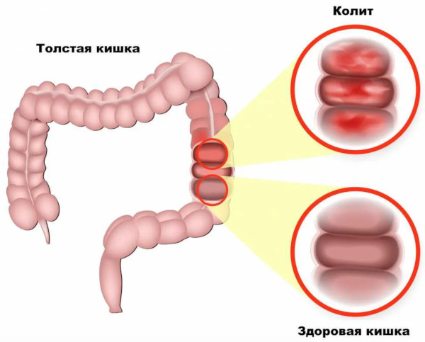 Колит кишечника у ребенка. Симптомы и лечение