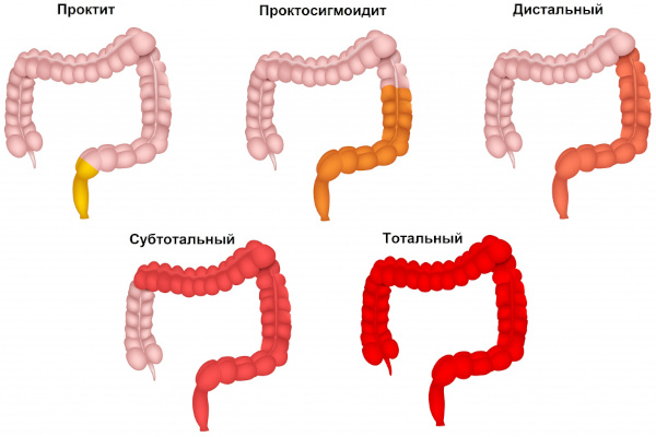 Колит кишечника у ребенка. Симптомы и лечение