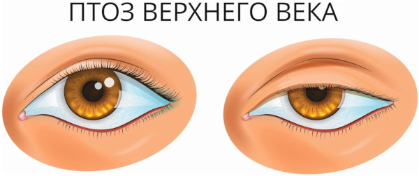 Компьютерная периметрия глаза. Что это такое в офтальмологии