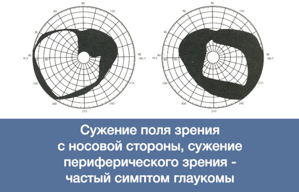Компьютерная периметрия глаза. Что это такое в офтальмологии