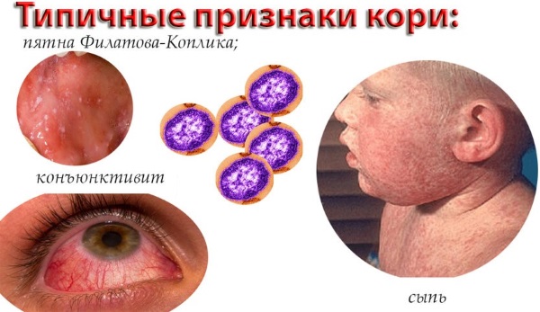Сыпь при инфекционных заболеваниях. Виды, диагностика, как отличить у детей, взрослых, как лечить
