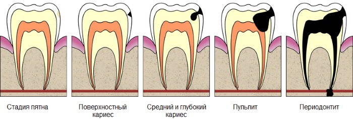 Как вылечить кариес без стоматолога у ребенка, подростка