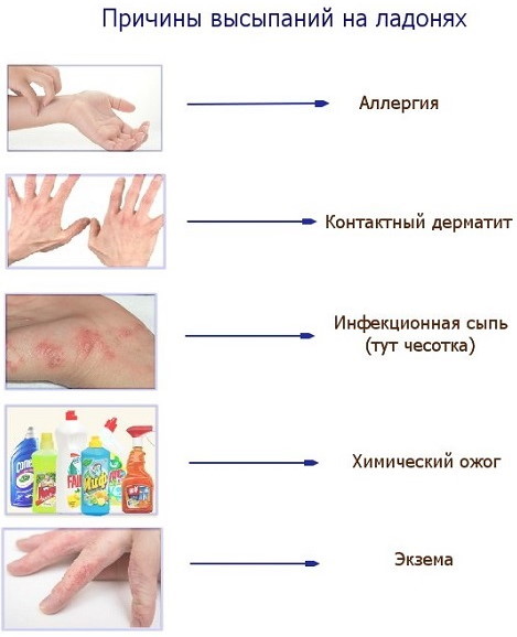 Красные ладошки у ребенка, красные пятна, точки. Причины