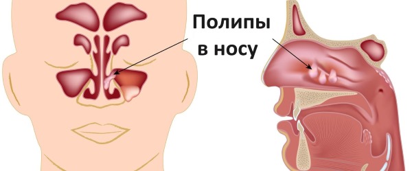 Экссудативный гайморит. Что это, лечение у взрослых без прокола