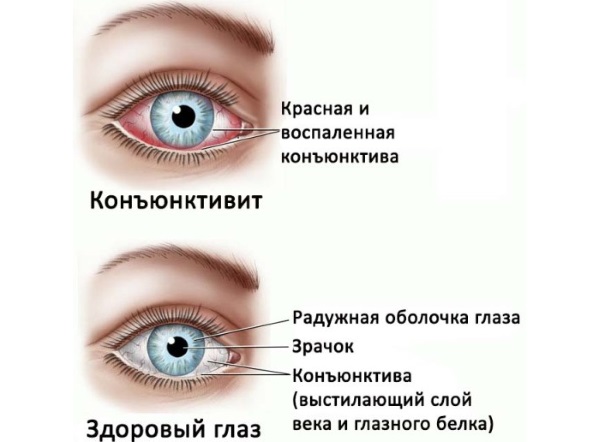 Инородное тело в глазу. Первая помощь, куда обратиться, капли