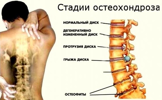 Нарушение статики шейного отдела позвоночника, поясничного, пояснично-крестцового, грудного