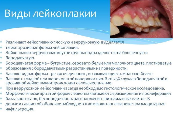 Лейкоплакия полости рта. Фото, дифференциальная диагностика