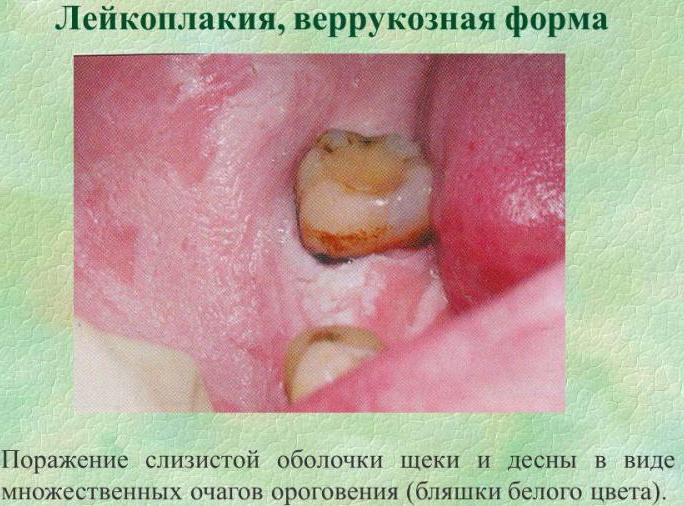 Лейкоплакия полости рта. Фото, дифференциальная диагностика