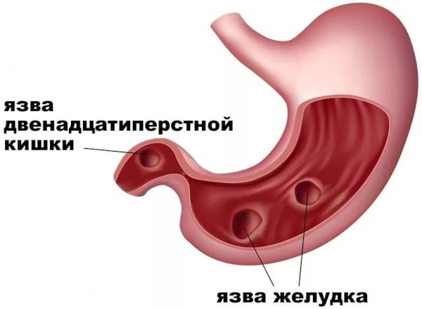 Лорноксикам (Lornoxicam) уколы. Инструкция по применению