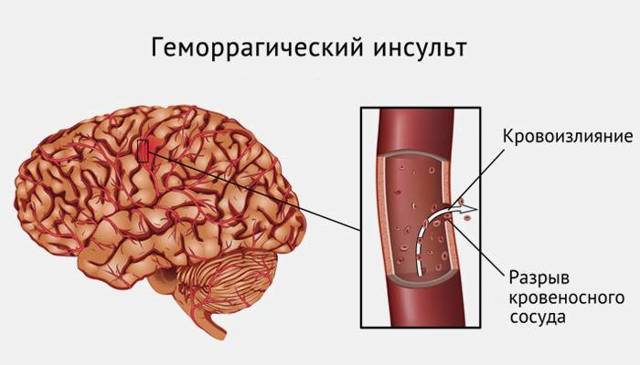 Последствия клещевого энцефалита головного мозга