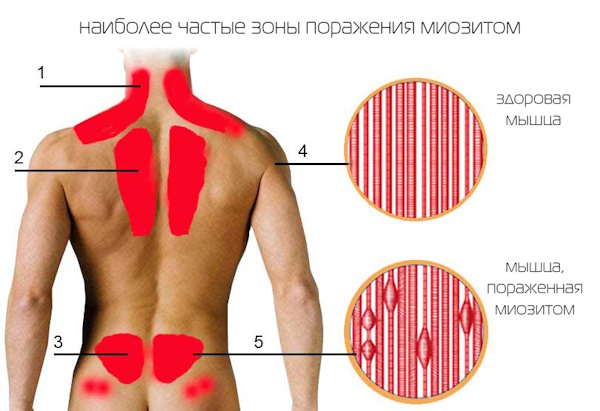 Блокада пояснично-крестцового отдела позвоночника при болях в пояснице