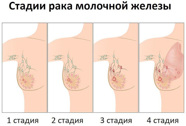 Мастэктомия (удаление молочной железы). Что это такое, фото, виды