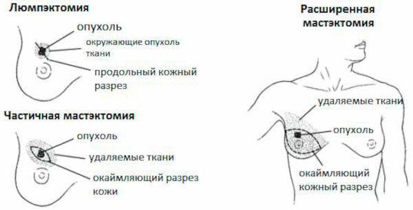 Мастэктомия (удаление молочной железы). Что это такое, фото, виды