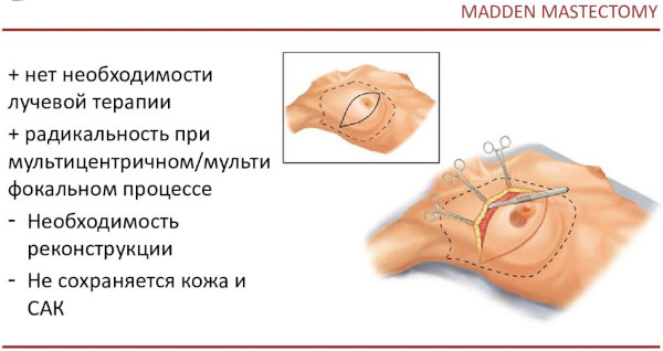 Мастэктомия (удаление молочной железы). Что это такое, фото, виды