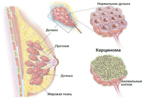 Мастэктомия (удаление молочной железы). Что это такое, фото, виды