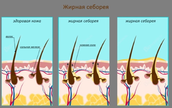 Себорейный дерматит на голове. Фото, лечение, мази, кремы, шампуни