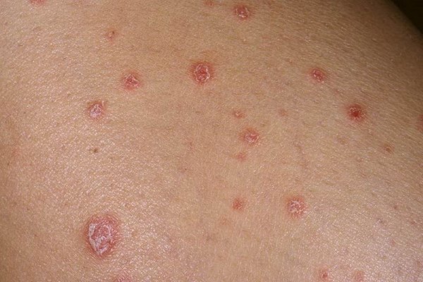 Мазь Салициловая. Инструкция по применению, лечебные свойства, как применять