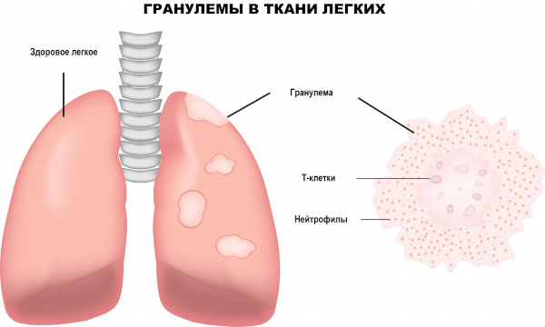 Медиастинальная лимфаденопатия легких. Что это такое, как лечить
