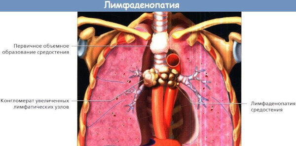 Медиастинальная лимфаденопатия легких. Что это такое, как лечить