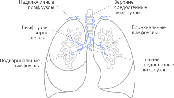 Медиастинальная лимфаденопатия легких. Что это такое, как лечить