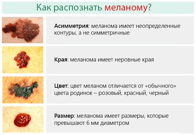 Родинка чешется. Причины у женщины, что делать