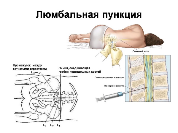 Менингит у детей 5-10 лет. Симптомы, как проявляется