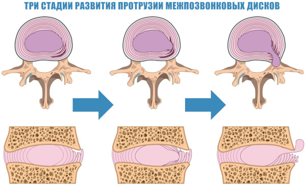 Межпозвоночные диски. Строение, анатомия, функции