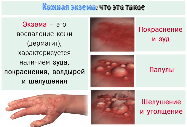 Чесотка у детей. Лечение, препараты, народные средства, что это такое, профилактика