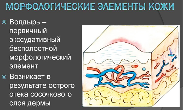 Морфологические элементы кожи первичные и вторичные. Таблица