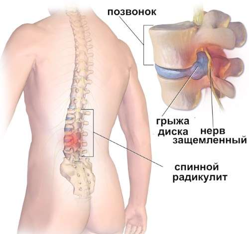 Продуло спину в районе поясницы. Как лечить