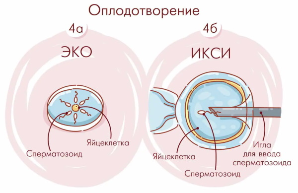 Мужское бесплодие. Лечится или нет, причины, симптомы