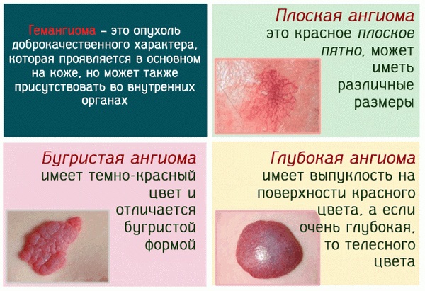 Родинка чешется. Причины у женщины, что делать