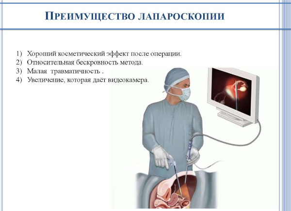 Что нельзя делать после лапароскопии