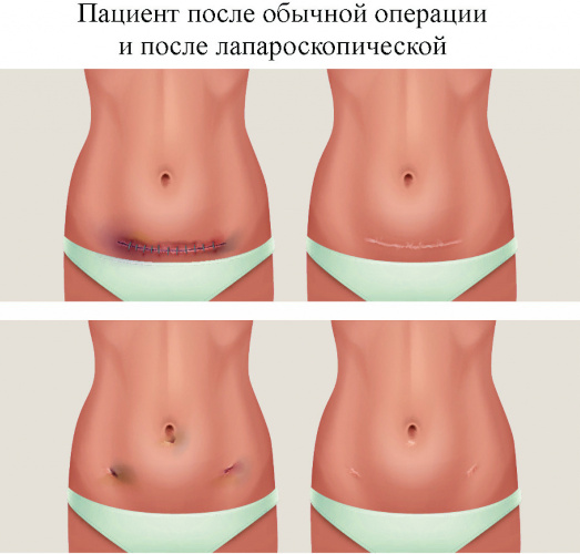Что нельзя делать после лапароскопии