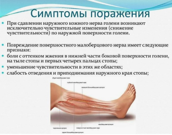 Невропатия (неврит) малоберцового нерва. Симптомы, лечение