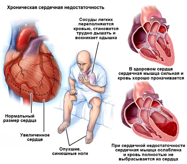 Компресс для горла при ангине, воспалении лимфоузлов на шее