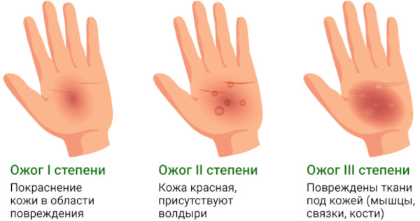 Облепиховое масло при ожогах. Инструкция по применению