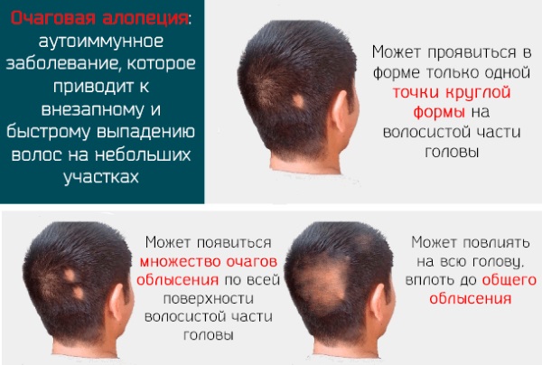 Облысение у женщин. Причины и лечение, фото гормональное, возрастное. Народные средства, препараты, витамины, процедуры