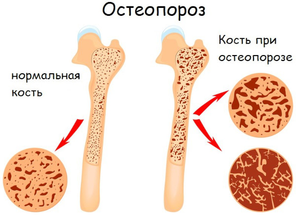 Омега-3 для суставов и связок. Какая лучше, польза