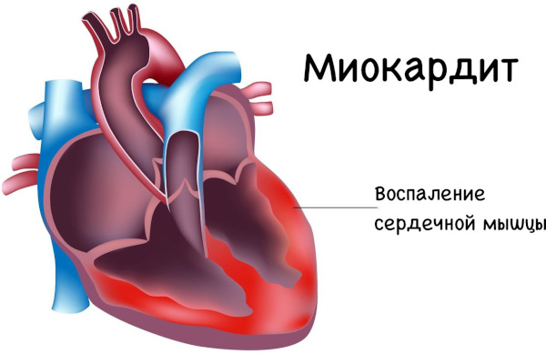 Опасность пневмонии. Осложнения, последствия болезни