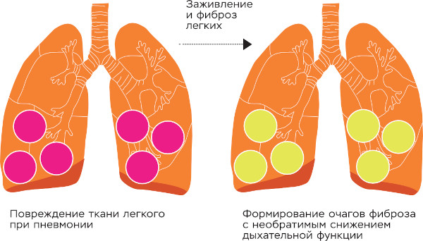 Опасность пневмонии. Осложнения, последствия болезни