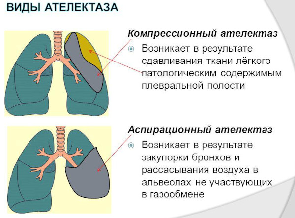 Опасность пневмонии. Осложнения, последствия болезни