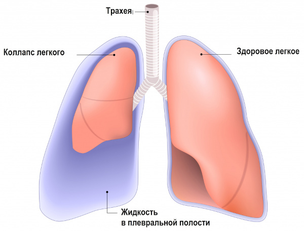 Опасность пневмонии. Осложнения, последствия болезни