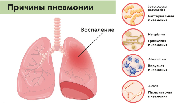 Опасность пневмонии. Осложнения, последствия болезни