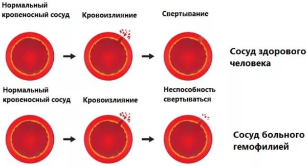 Операция по удалению гинекомастии у мужчин. Цена, как проходит
