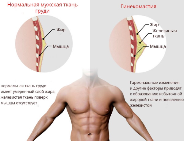 Операция по удалению гинекомастии у мужчин. Цена, как проходит